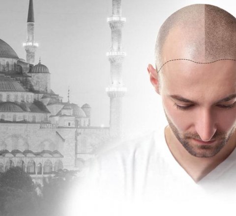 Turkey: The Mecca of Hair Transplants in Europe